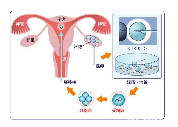 鲜胚移植