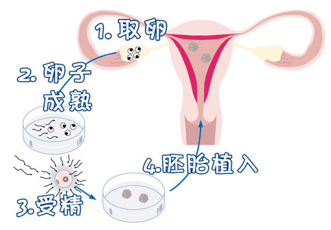雌激素低不孕